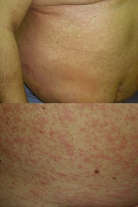 Generalized urticaria (top) and subsequent maculopapular
exanthema (bottom) caused by heparin