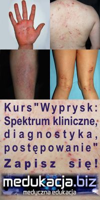 Kurs: Wyprysk - Spektrum kliniczne, diagnostyka, postpowanie